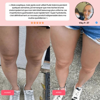 Masseur Anti-Cellulite 3 en 1 - SkinLift™